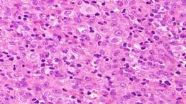 cytoplasm with ill-defined cell borders Most tumors