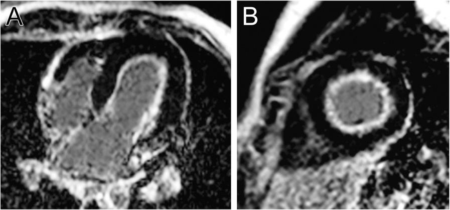 Late gadolinium enhancement image in a ventricular short-axis view showing enhancement and wall thinning of the inferior septum consistent with a chronic myocardial infarction.