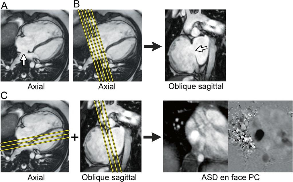 Fratz et al. Journal of Cardiovascular Magnetic Resonance 2013, 15:51 Tetralogy of Fallot following complete repair Standard imaging 1. Ventriculography module 2.