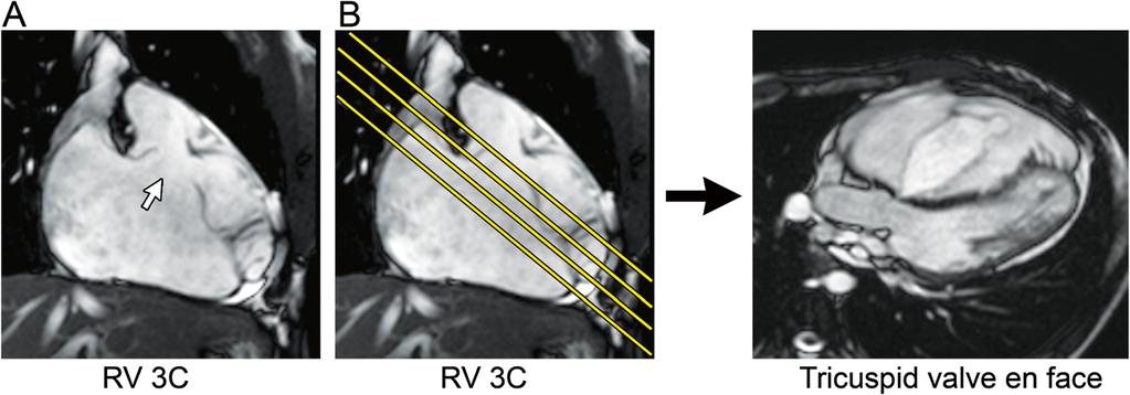 The axial SSFP image is used to plan a stack of oblique sagittal SSFP cine images to visualize the defect in an orthogonal view and assess its superoinferior dimension. 4.