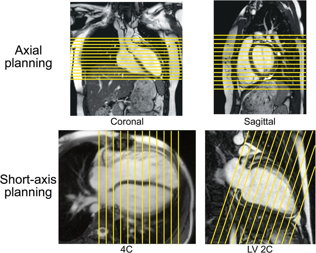 Fratz et al. Journal of Cardiovascular Magnetic Resonance 2013, 15:51 Page 9 of 26 Figure 7 Planning for ventriculography.