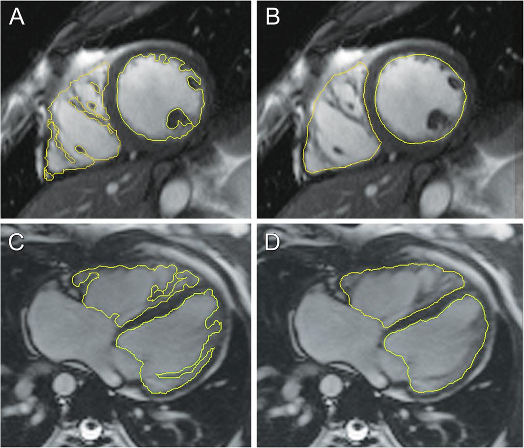 A short-axis stack of cine images for ventriculography is planned by adjusting the slice locations on 4chamber (4C) and left ventricular 2-chamber (LV 2C) images in diastole (bottom row).