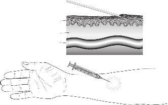 Vascular Access Figure 8: Three-point technique for needle insertion Drawing adapted with permission from Lynda Ball Figure 9: Intradermal injection of local anesthetic movement, place the thumb and