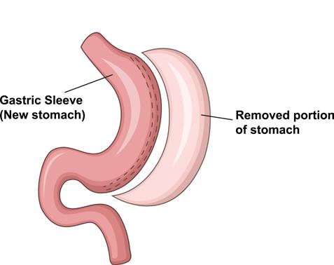 Surgical Procedure Sleeve Gastrectomy In this surgery, part of the stomach (approximately 75-90%) is removed leaving the patient with a long banana shaped stomach. The intestines are not altered.