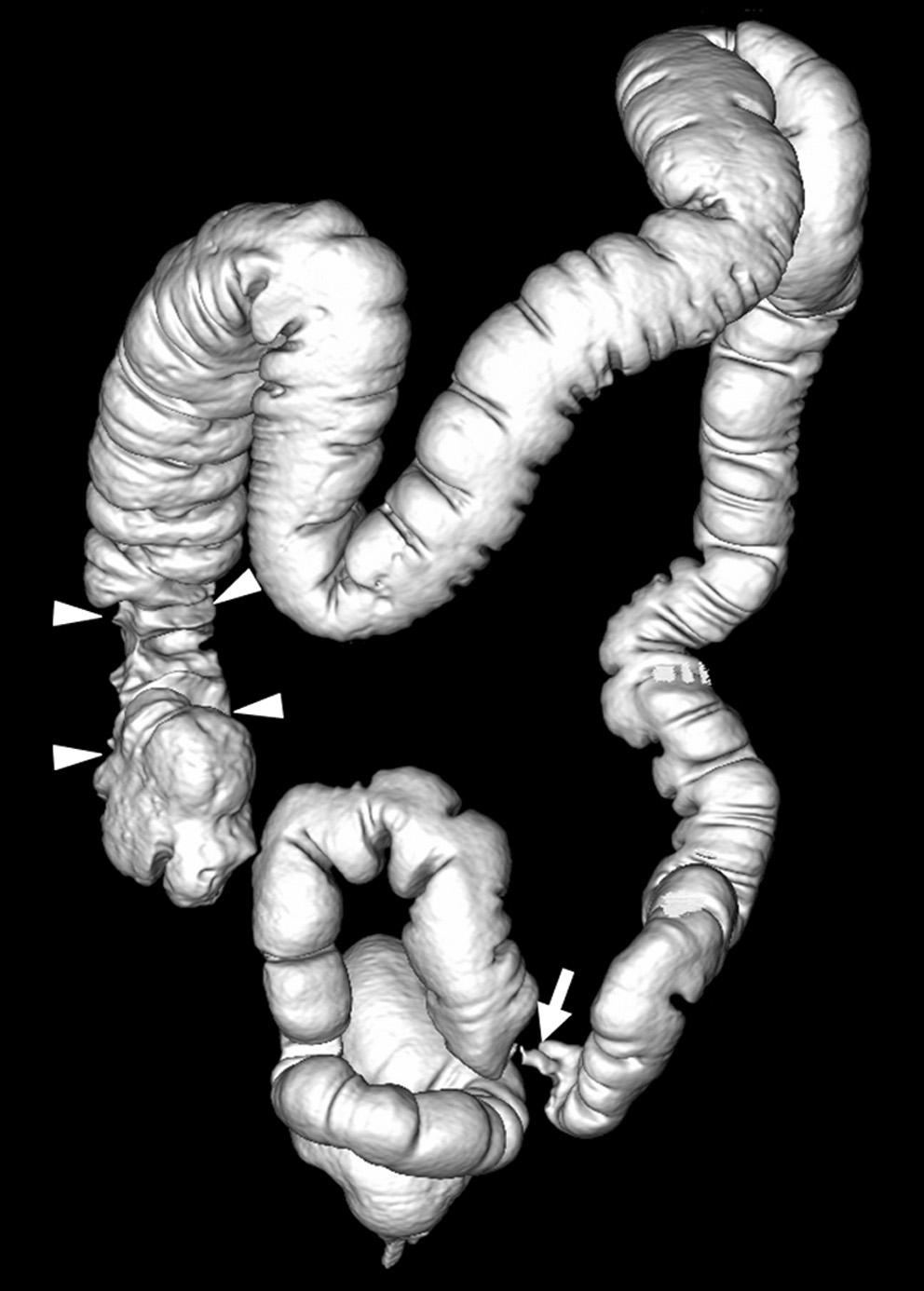 A volume-rendered surface-shaded image of a CTC showed an apple-core shaped, concentric narrowing in the sigmoid colon (Fig. 1C).