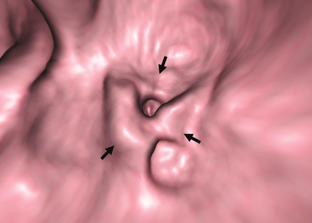 1D), which led to a narrowing of the colon. An irregular fold thickening and mild luminal narrowing (Fig. 1E) was also observed via a virtual endoscopic image of the ascending colon.