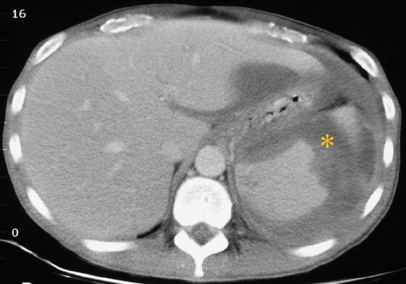 ACUTE PERIPANCREATIC FLUID COLLECTION Fig 2. Axial intravenous contrast enhanced CT image showing an acute fluid collection extending into the spleen (star) in a patient with acute pancreatitis.