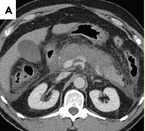ACUTE NECROTIC COLLECTION (ANC) Fig 6.