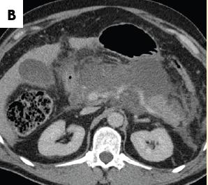 acute necrotic collection (ANC). Initial presentation CT image (A) shows extensive patchy pancreatic enhancement (arrow).