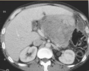 Subsequent CT performed on acute admission with abdominal pain (B) shows interval enlargement of the pseudocyst with heterogeneous high density content (arrow),