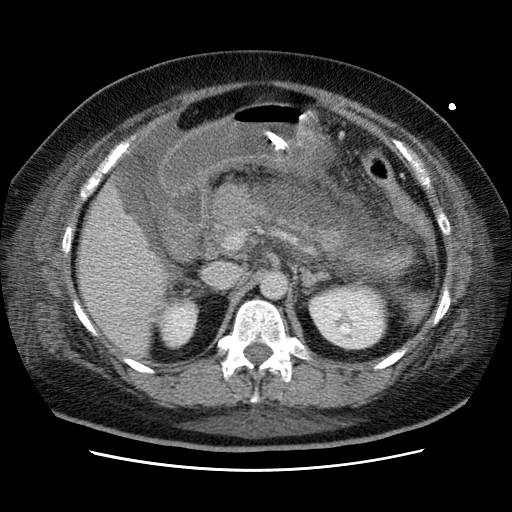 SPLENIC VEIN THROMBOSIS Fig 13. Axial contrast-enhanced CT images (A-C) over a 2 year interval.