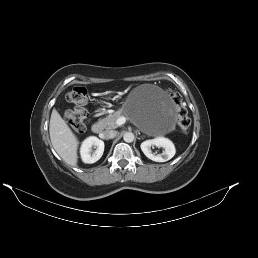 Interval CT performed 2 years later (B, C) demonstrate nonopacification of the splenic vein consitent with chronic thrombosis.