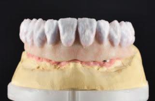 The reduced tooth shape allows the veneering ceramic to be applied in an even thickness. This ensures that the layered ceramic is heated uniformly during firing.