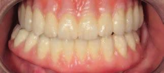 For example, the keratinised gingiva is recreated with light pink materials, as the blood circulation is naturally less in this area, whereas the mucogingival area is imitated using more intensive