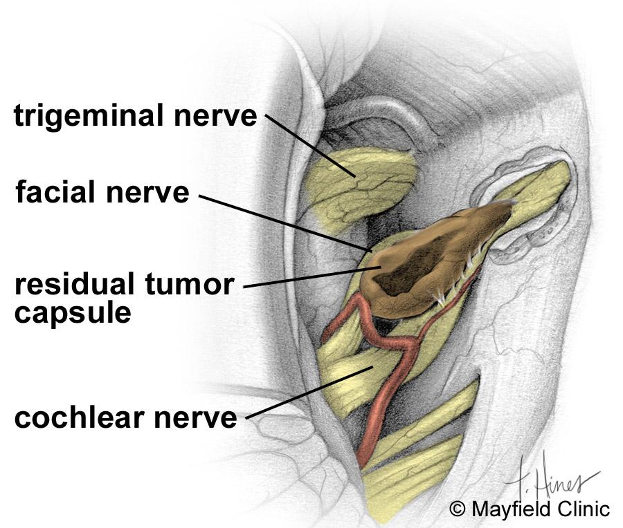 Step 4: debulk the tumor Depending on the size, acoustic neuromas can be attached to the facial nerve, trigeminal nerve, brainstem, and blood vessels.