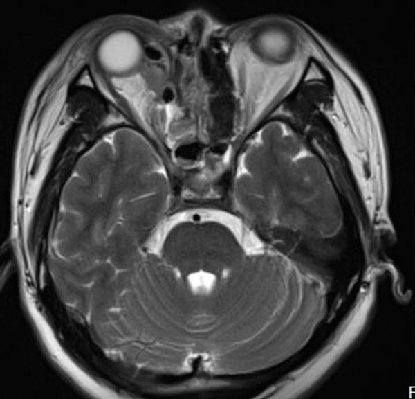 Figure 5. Right intra-orbital disorderly signal and optic nerve injury in a MRI image of the same patient with type-ii and stage-ii chronic rhino-sinusitis and nasal polyp 6 hours after operation.