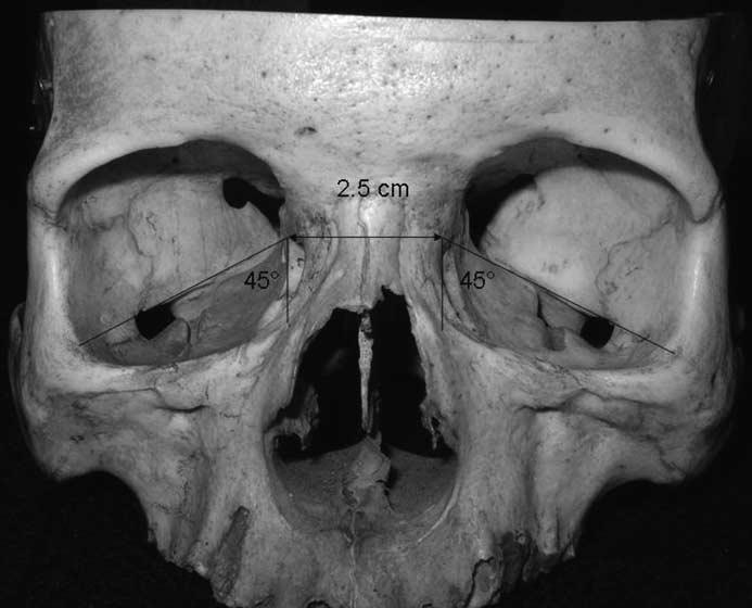 It is formed mainly by the orbital plate of the maxilla with contributions from the zygoma anterolaterally and the palatine bone at its most posterior limit.