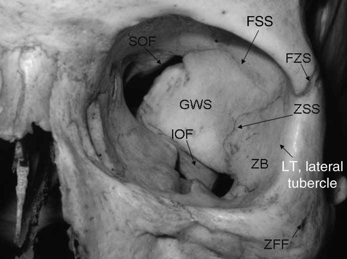 maxilloethmoid suture; ZB, zygomatic bone. Figure 6 Anatomy of the lateral orbital wall, anterior view.