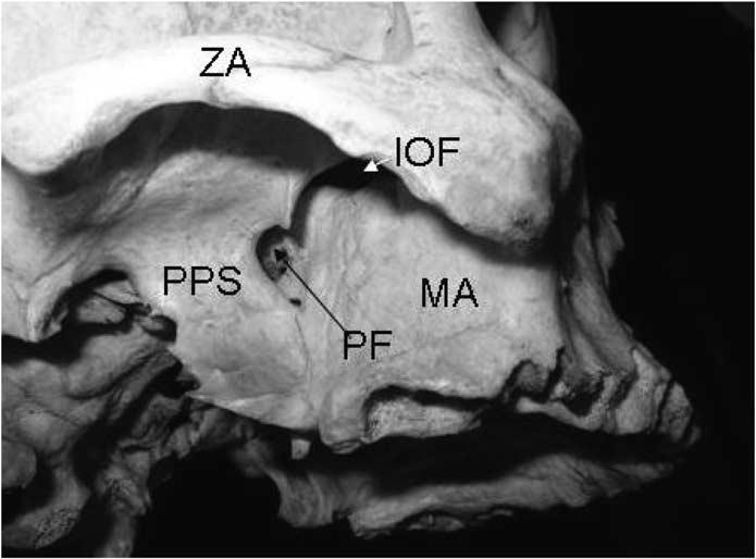 1124 Update on orbital anatomy Figure 9 Anatomy and relationships of the infratemporal and pterygopalatine fossae.