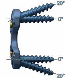 Universal Plates are designed to allow for 20 cephalad angulation on the superior screw and 20 caudal