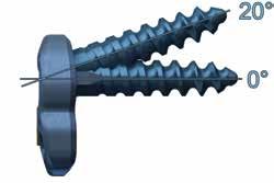 Sacral Plates are designed for 20 cephalad angulation on the superior screw and 10  The Buttress Plate is