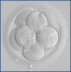 Radical Trachelectomy (Cervical Cancer) Natural Conception In Vitro Fertilization Donor