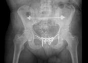 44 years old * Pelvic fracture *