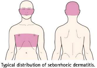 B-Seborrheic dermatitis 1-Seborrheic dermatitis (Seborrhea) is the result of accelerated epidermal proliferation and sebaceous gland activity on the scalp, face, and trunk (3).
