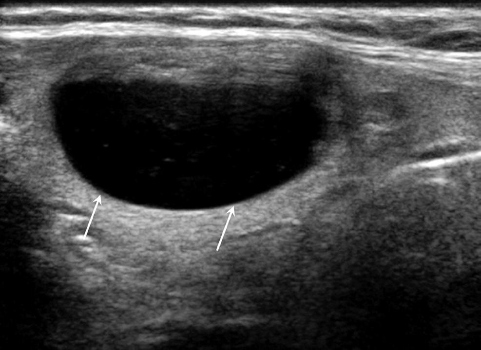 Yu-Mee Sohn, et al. A Fig. 2. A 51-year-old woman with a thyroid nodule in the right thyroid on US. Initial FNAB revealed the nodule to be benign on cytology, and follow-up FNAB after 1.