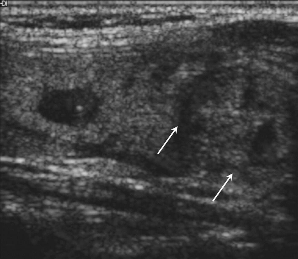 (B) On follow-up US, this nodule showed decreased size and suspicious US changes including hypoechoic and microlobulated margins and taller-than wide shape (arrows).