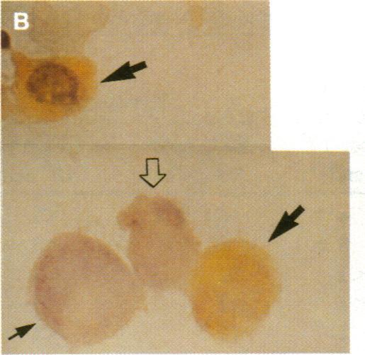 recognizable neutrophils (large open arrow) and metamyelocyte (small solid arrow). (x600.) (C) The neutrophilic cells in the same colony were histochemically positive for peroxidase. (x 1,800.