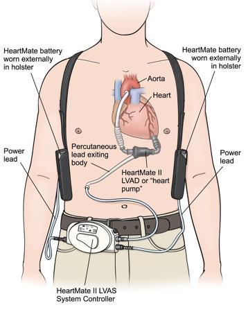 What is an LVAD (MCS)? VADs save lives and improve quality of life.