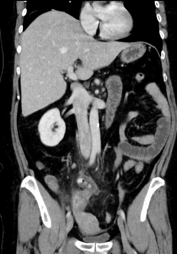 Appendicitis in a 57 year old woman.