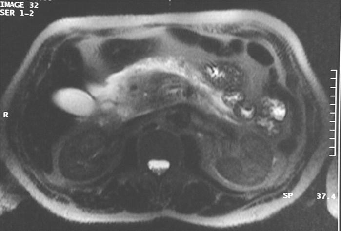 Magnetic resonance imaging (MRI) Imaging features pancreatic edema (low T1 / high T2)