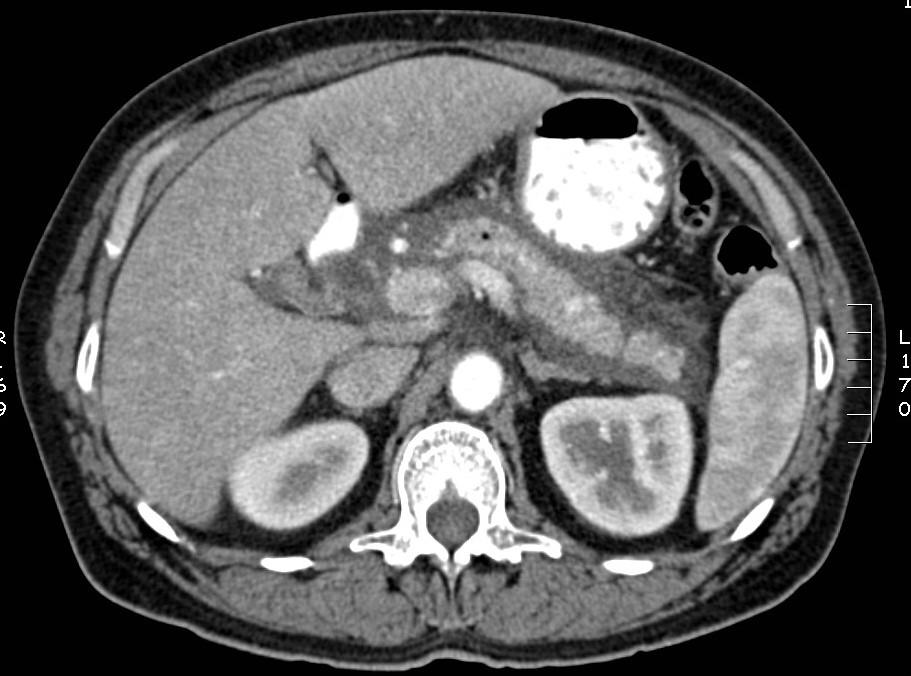 Acute pancreatitis: imaging strategies (E)US in the early management to select those who would benefit from endoscopic stone extraction and drainage