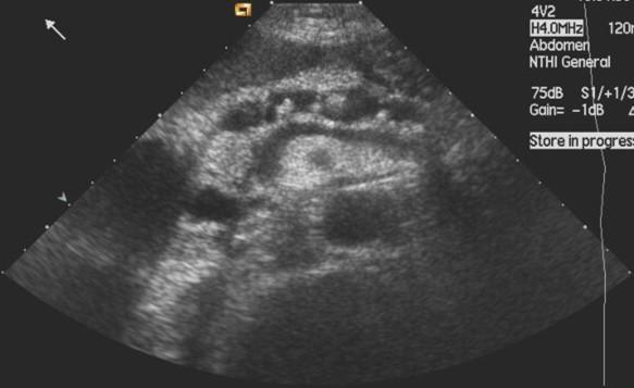 Transabdominal US Features Calcifications