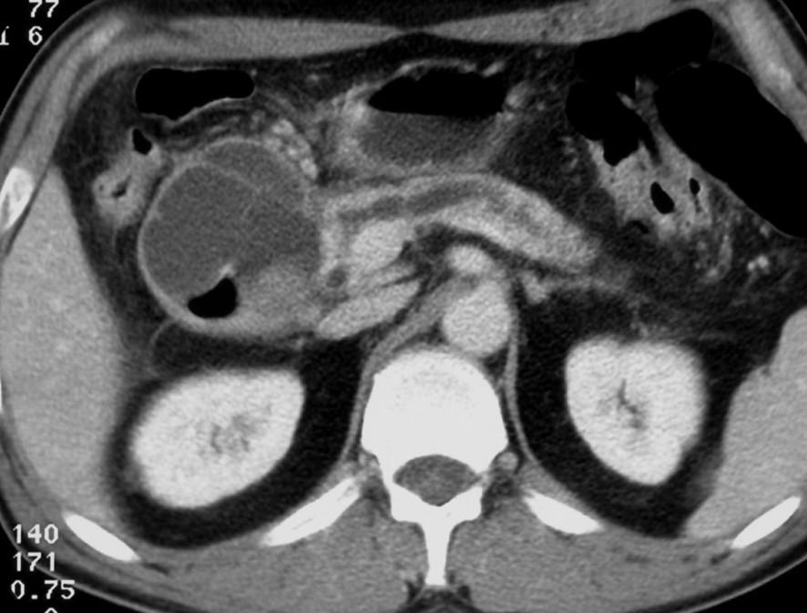 CT features Features calcifications duct dilation parenchymal atrophy intra- and