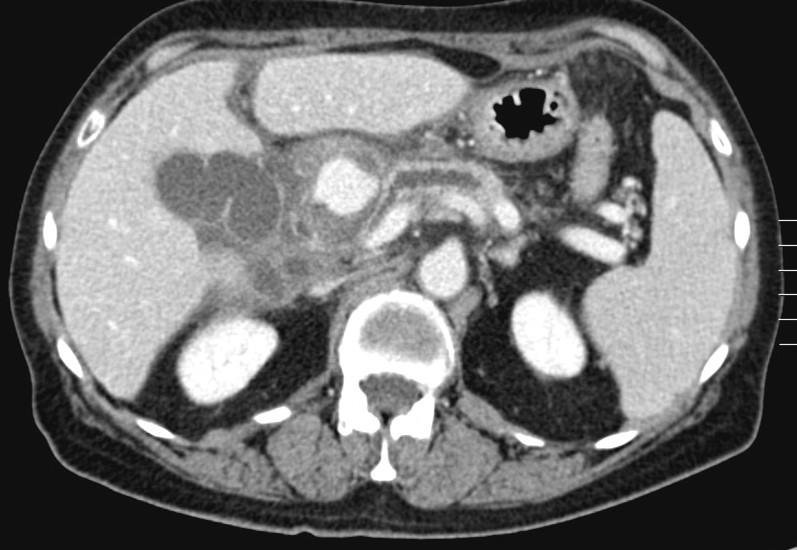 CT: complicated chronic