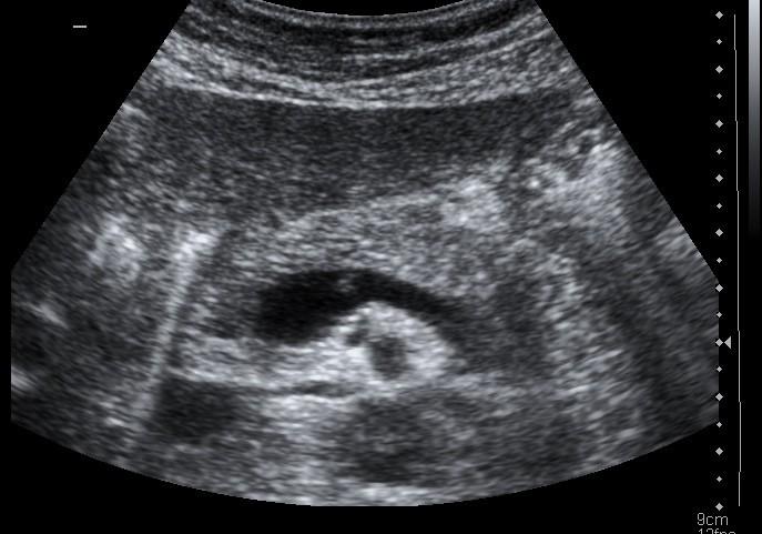 Transabdominal ultrasound (US) Can