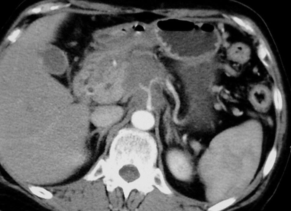 Staging: tumor is resectable or not?