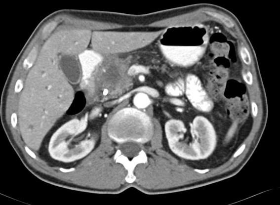 Staging: tumor is resectable or not?