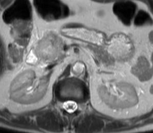 MRI Diagnosis of tumor