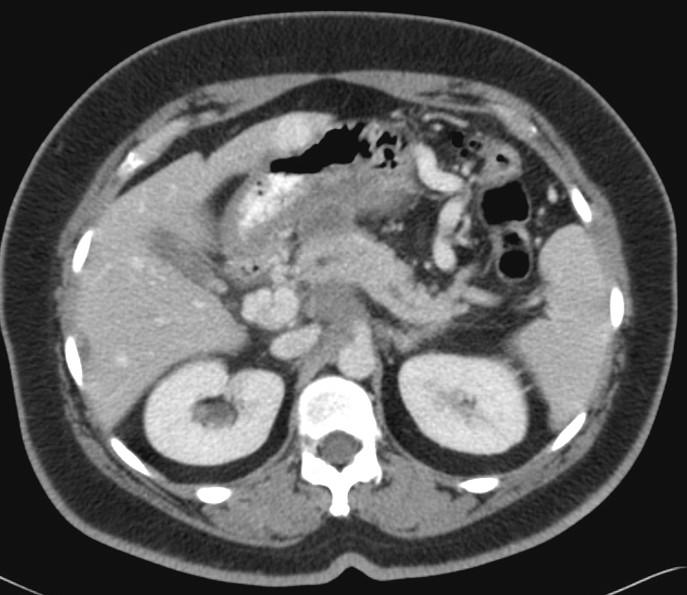 Pancreatic tumors: imaging strategies Detection US (large/head) CT EUS,