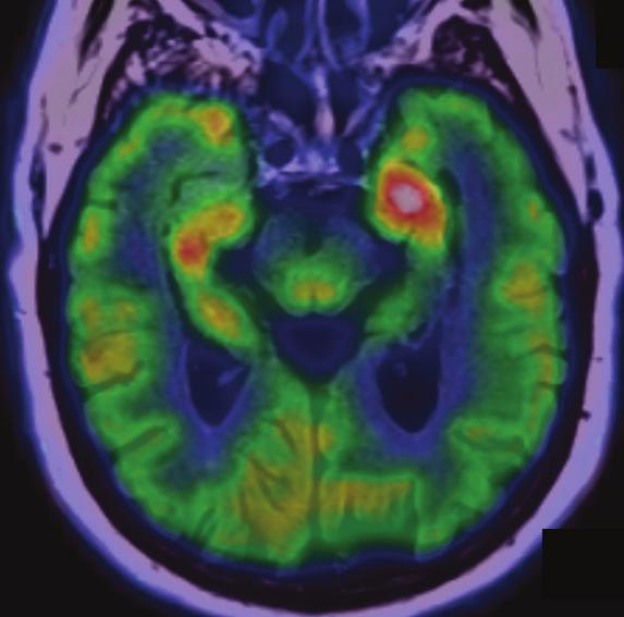 positive EEG findings EEG finding 1 4 CT NA NA 159 NA Normal 2 46 MRI 109 PET 46 81 Vertex seizure 3 73 MRI 120 PET 83 180 Periodic