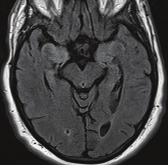 frontotemporal seizure 7 9 CT 33 PET 14 18 Bifrontal seizure Average 48.6 80.0 80.0 96.