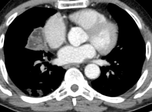 Lung consolidation in right middle and