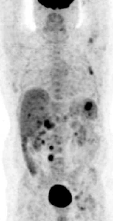 Cystic fibrous dysplasia 62 year-old man with