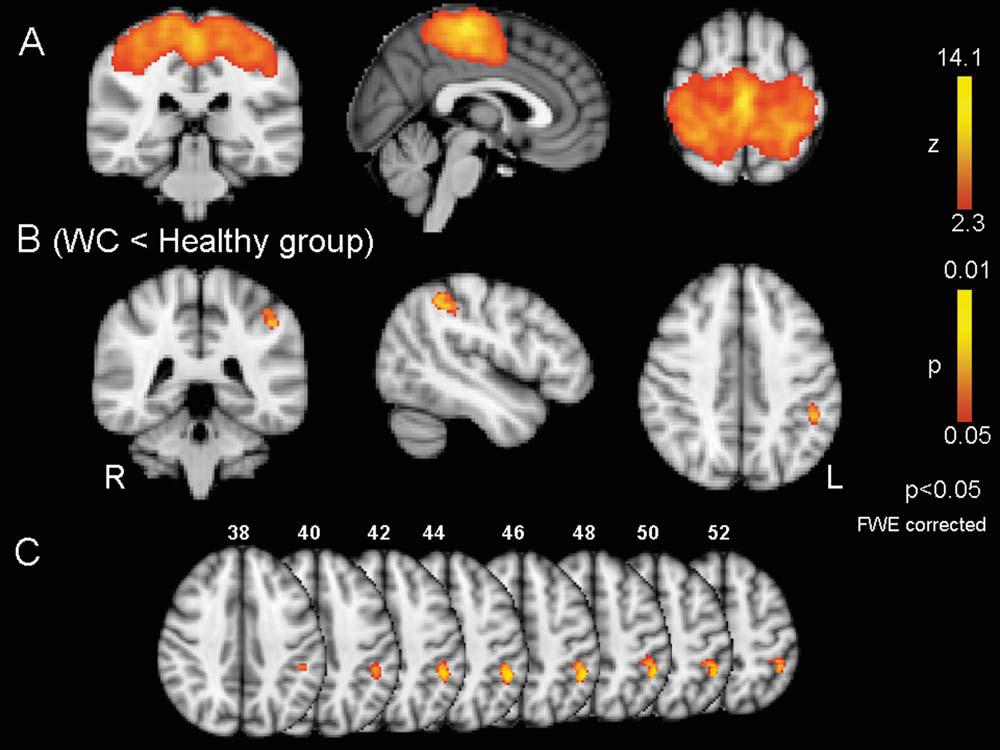 Resting-state functional connectivity changes