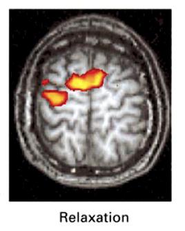 (fmri) Dresel Brain 2006 Abnormal cerebello-cortical motor network