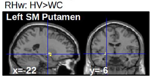 during fmri recording Right hand Left hand Right foot Writing Connectivity analysis: * 40 Writer s cramp Reduced Pu